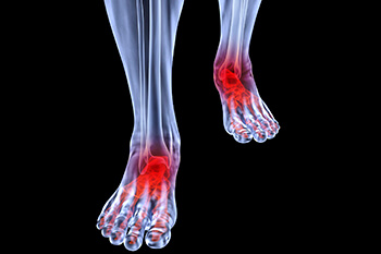 Arthritic Foot Specialist Oceanside, CA 92056 Arthritic foot care in the San Diego County, CA: Oceanside (Carlsbad, Vista, San Marcos, Escondido, Encinitas, Solana Beach, Valley Center, Poway, Camp Pendleton North, Fall Brook) areas