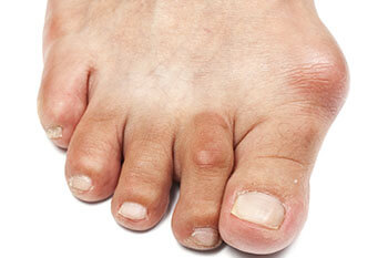 Bunion Surgery in Oceanside, CA 92056 Bunions treatment in the San Diego County, CA: Oceanside (Carlsbad, Vista, San Marcos, Escondido, Encinitas, Solana Beach, Valley Center, Poway, Camp Pendleton North, Fall Brook) areas