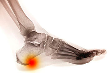 Heel Spurs Specialist in Oceanside, CA 92056 Heel spur treatment in the San Diego County, CA: Oceanside (Carlsbad, Vista, San Marcos, Escondido, Encinitas, Solana Beach, Valley Center, Poway, Camp Pendleton North, Fall Brook) areas