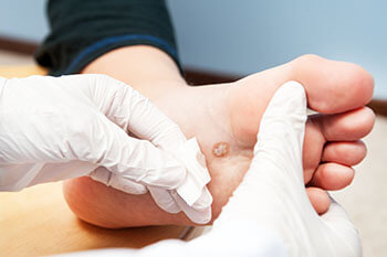 Plantar Warts Specialist Oceanside, CA 92056 Warts treatment in the San Diego County, CA: Oceanside (Carlsbad, Vista, San Marcos, Escondido, Encinitas, Solana Beach, Valley Center, Poway, Camp Pendleton North, Fall Brook) areas